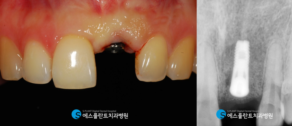 심미성과 기능성을 모두 고려한 압구정로데오 에스플란트치과병원의 앞니 임플란트 (가이드 임플란트) 관련 이미지 6