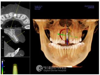 [앞니임플란트] 앞니 임플란트가격, 어금니 임플란트 가격 관련 이미지 5