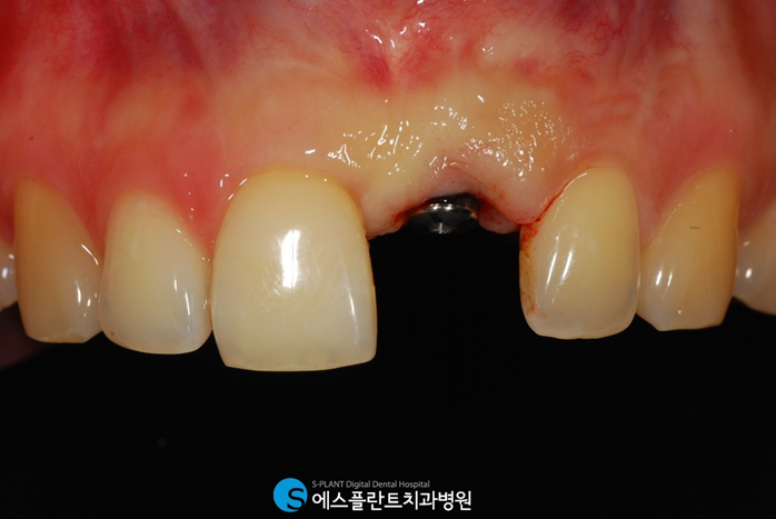 앞니를 상실했다면? 앞니임플란트가 있습니다! 관련 이미지 4