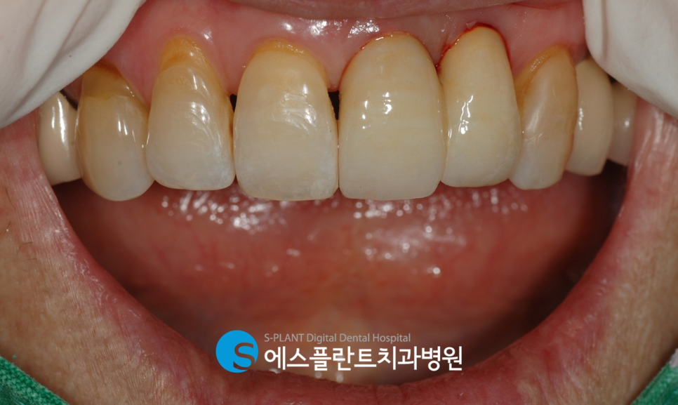 압구정 임플란트 잘하는 치과, 앞니 치관치근 파절 인한 임플란트 수술이 가능한 에스플란트치과병원 관련 이미지 7
