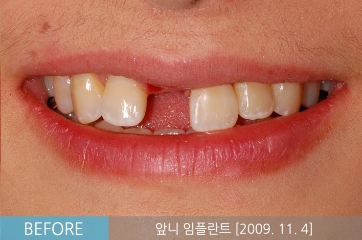 [앞니임플란트기간] 앞니임플란트, 당일 발치 후 즉시 식립 임플란트 CASE 관련 이미지 5