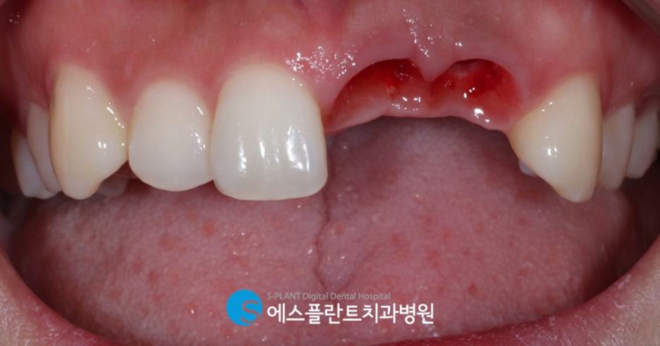 앞니 임플란트 잘하는 강남 치과, 에스플란트치과병원의 만족도 높은 앞니 심미 임플란트 관련 이미지 3