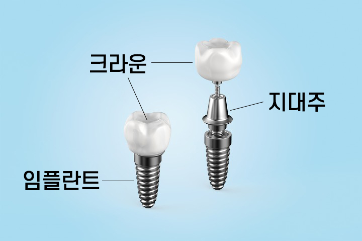 치과마다 임플란트 가격이 다른 이유는 무엇인가요? [에스플란트 치과병원] 관련 이미지 1