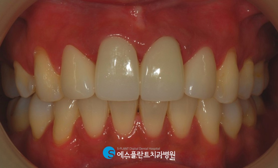압구정로데오 앞니 벌어짐 정중이개 치료 잘하는 치과, 에스플란트치과병원의 전치부 심미보철 관련 이미지 5