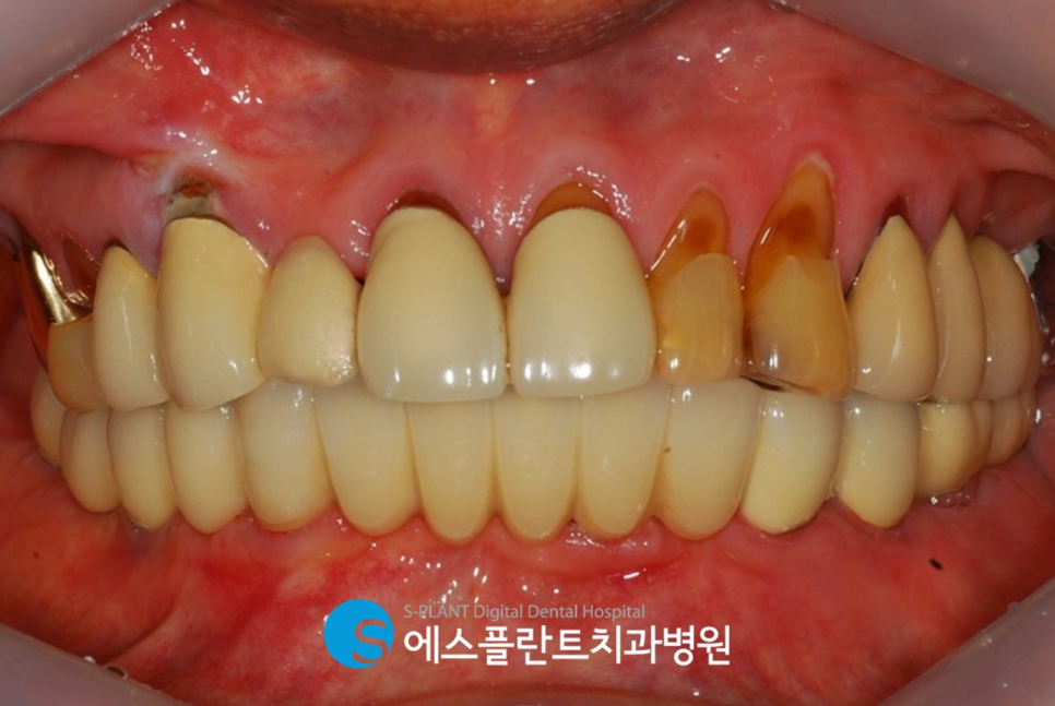 하악 다수 임플란트 식립 시에는 청담 임플란트 잘하는 치과, 에스플란트치과에서 관련 이미지 7