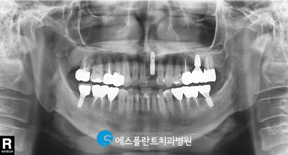 압구정로데오역 발치 후 즉시 임플란트 식립 잘하는 치과, 에스플란트 치과병원 관련 이미지 6