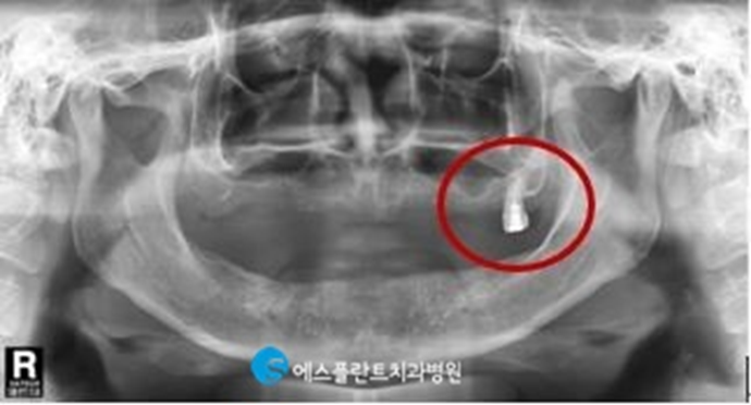 전악임플란트로 치아 기능을 회복하세요! <전악임플란트 치료사례> 관련 이미지 2