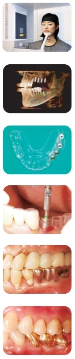 [강남구청역치과] 3D CT 임플란트, 임플란트 시술과정 관련 이미지 4
