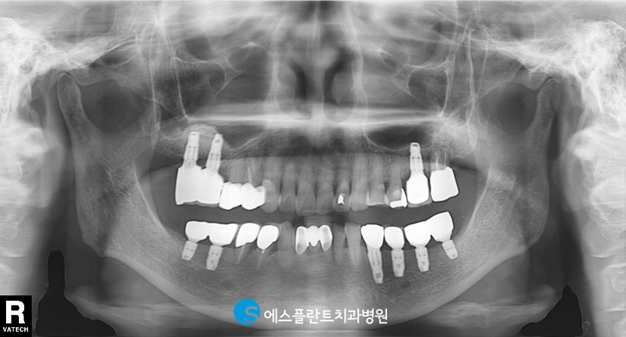 편안한 식사를 위한 어금니임플란트, 에스플란트치과에서 안전하게 진행하세요. 관련 이미지 6