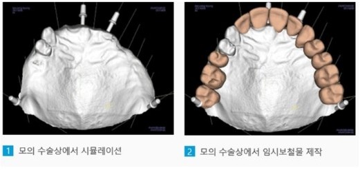 모의수술과 가이드를 통한 임플란트 치료 관련 이미지 7