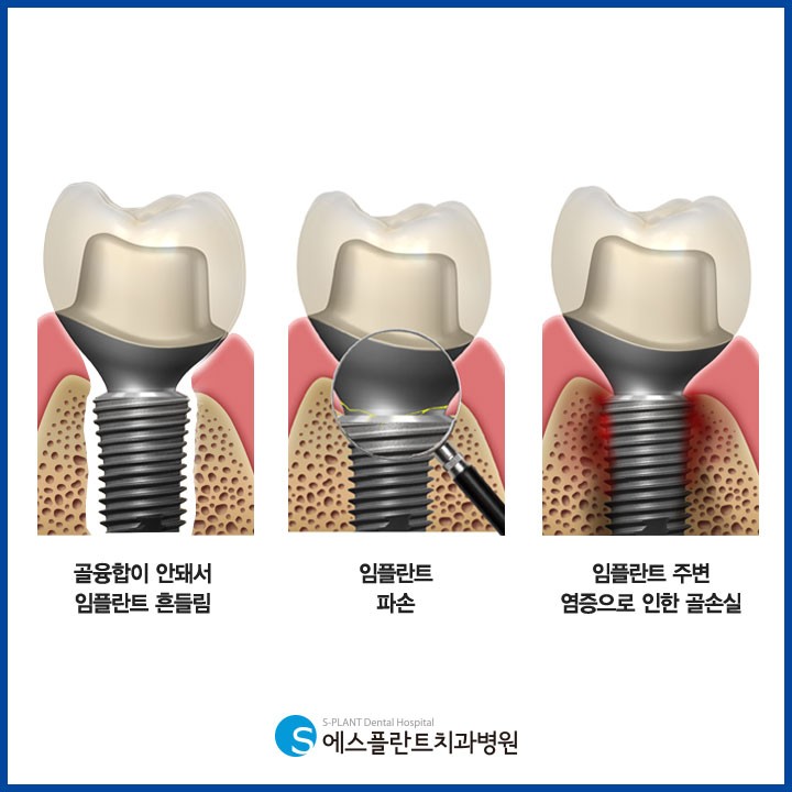 임플란트 재수술! 1차 수술과 다른점은?! 관련 이미지 3