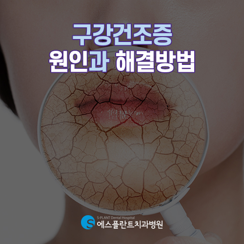 구강건조증 원인과 생활습관 개선 [에스플란트 치과병원] 관련 이미지 1