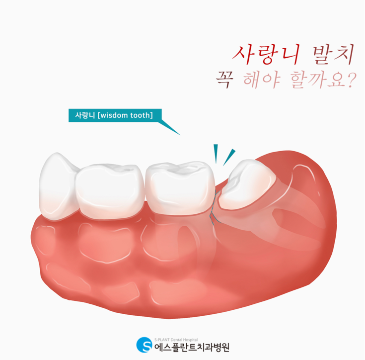 사랑니 발치 꼭 해야 할까요? 관련 이미지 1