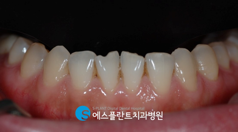 앞니 깨짐으로 인한 심미보철을 원한다면 - 강남 심미보철 잘하는 치과 에스플란트치과병원에서 관련 이미지 3