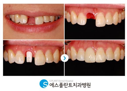 앞니 임플란트 내 치아처럼 자연스럽게 관련 이미지 7