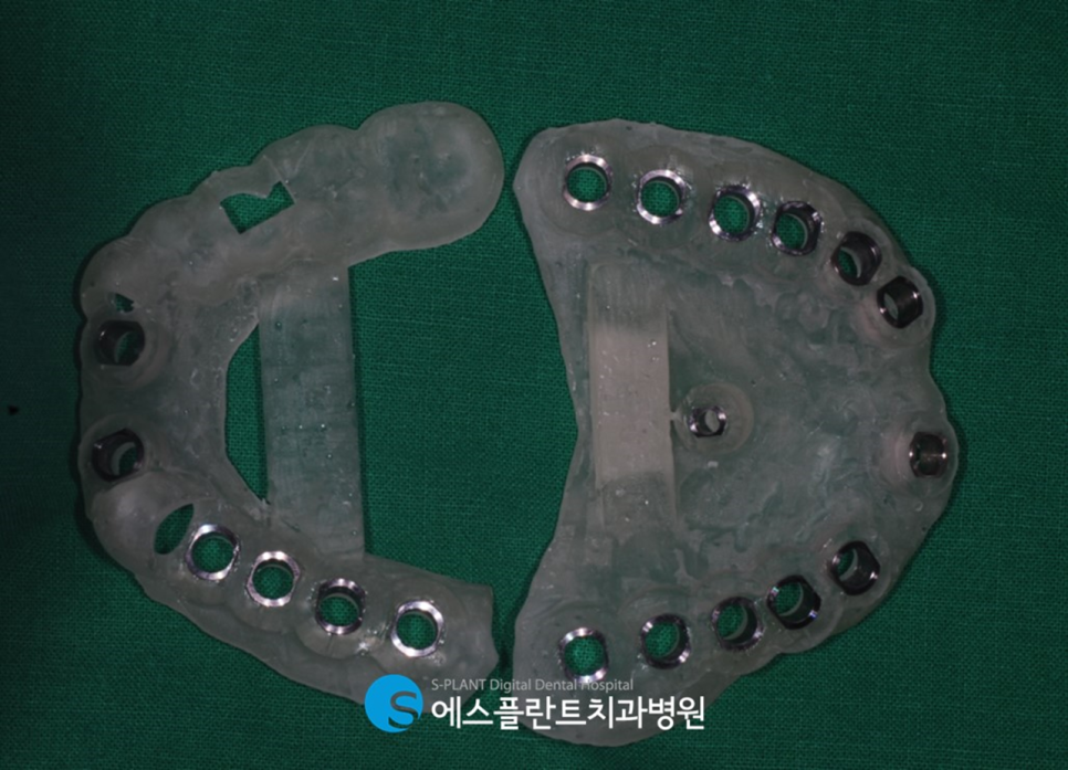 압구정 임플란트, 에스플란트치과병원의 편안하고 정확한 식립이 가능한 전악 가이드 임플란트 관련 이미지 7