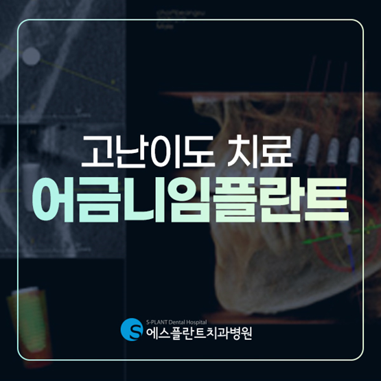 어금니임플란트를 통해 치아건강을 지키세요. 관련 이미지 1