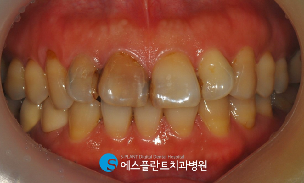 압구정 심미보철 치과, 에스플란트치과병원에서 치아를 예쁘고 가지런하게 관련 이미지 2