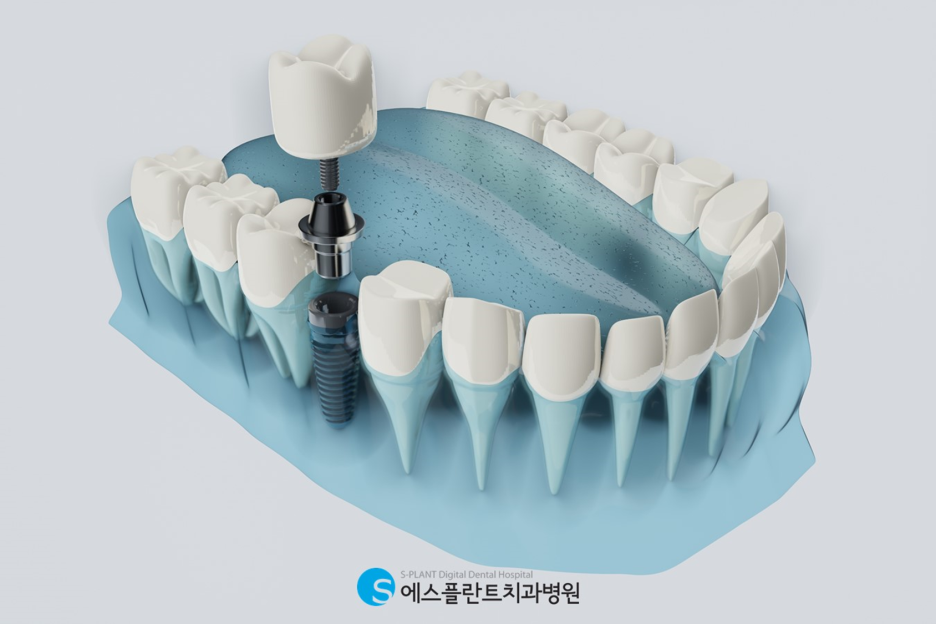 강남 임플란트, 보험 혜택으로 부담 없이 받는 방법 관련 이미지 2