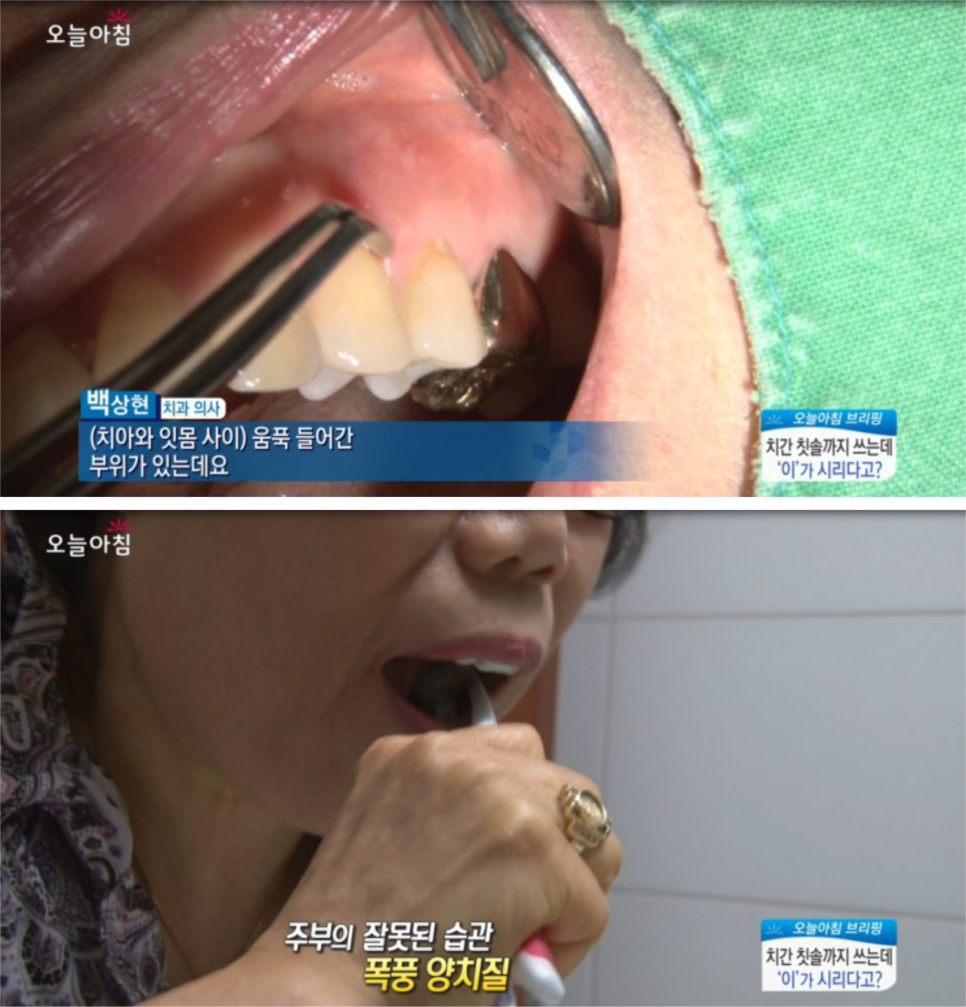 MBC생방송오늘아침_치간칫솔까지쓰면서관리해도시린이!왜?!_백 상현원장님 관련 이미지 3