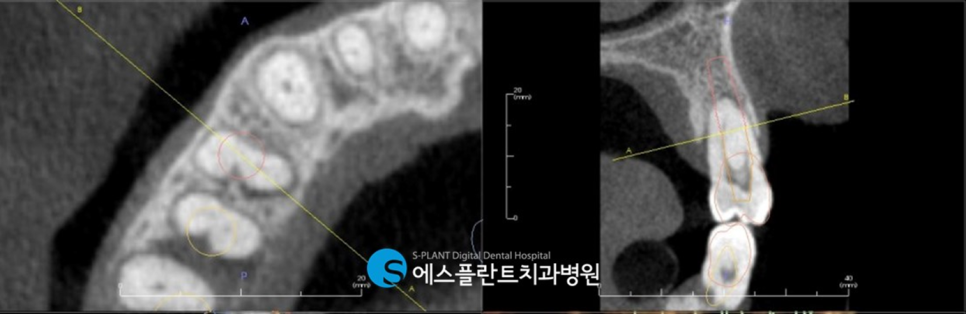 임플란트 잘하는 치과, 에스플란트 치과병원의 임플란트 모의수술과 가이드 제작으로 안전하게 관련 이미지 6