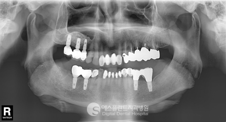 상악동 거상술 진행 후 임플란트 식립 실제사례 [에스플란트 치과병원] 관련 이미지 7