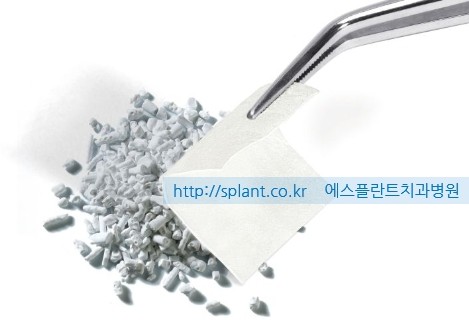 임플란트 뼈 이식, 왜 뼈 이식을 해야하는 걸까요? 관련 이미지 1