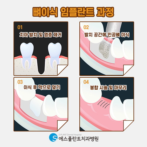 임플란트, 잇몸뼈가 부족하거나 약한 경우에는 어떻게 진행될까 [에스플란트 치과병원] 관련 이미지 4