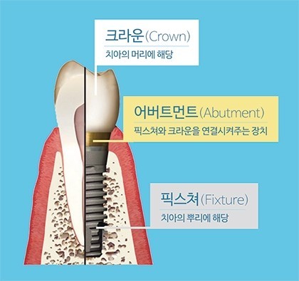 문제는_잇몸 뼈_뼈 이식이 왜 필요할까? 관련 이미지 1
