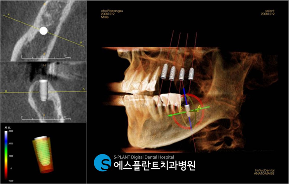 하악 대구치 임플란트 시 가이드 임플란트가 필요한 이유?! 하치조 신경 손상 피해 에스플란트 치과병원에서 정확하고 안전하게 관련 이미지 4
