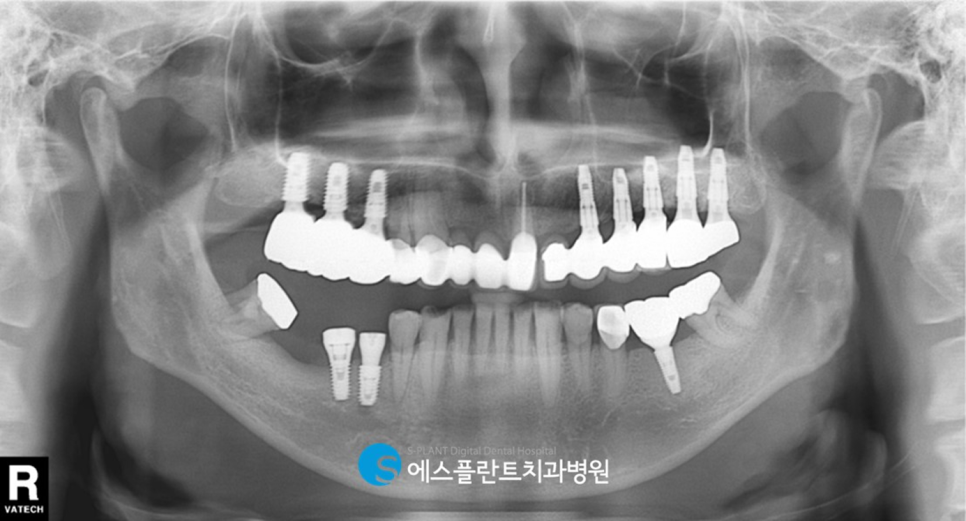 강남임플란트 잘하는 치과 에스플란트 병원의 오래된 브릿지 제거 후 임플란트 관련 이미지 5