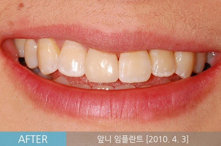 [앞니임플란트기간] 앞니임플란트, 당일 발치 후 즉시 식립 임플란트 CASE 관련 이미지 6