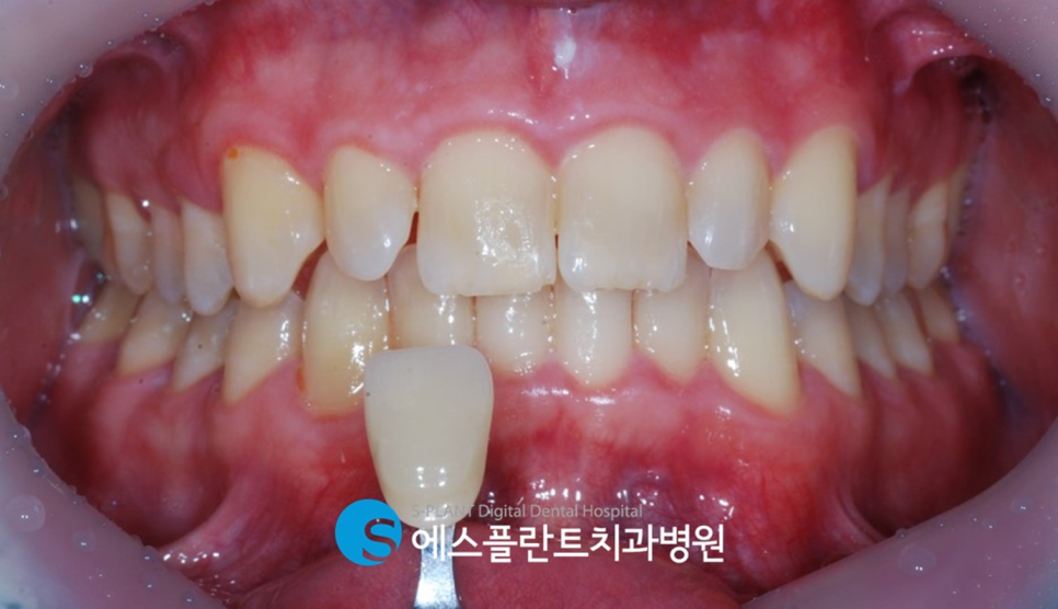 청담 에스플란트치과병원의 전치부 앞니 지르코니아 크라운 심미보철로 치아를 예쁘고 가지런하게 관련 이미지 6