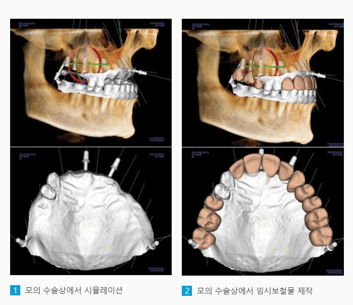 학동사거리 임플란트 잘하는 치과, 에스플란트치과병원의 디지털 가이드 임플란트로 정확하게 식립 관련 이미지 3