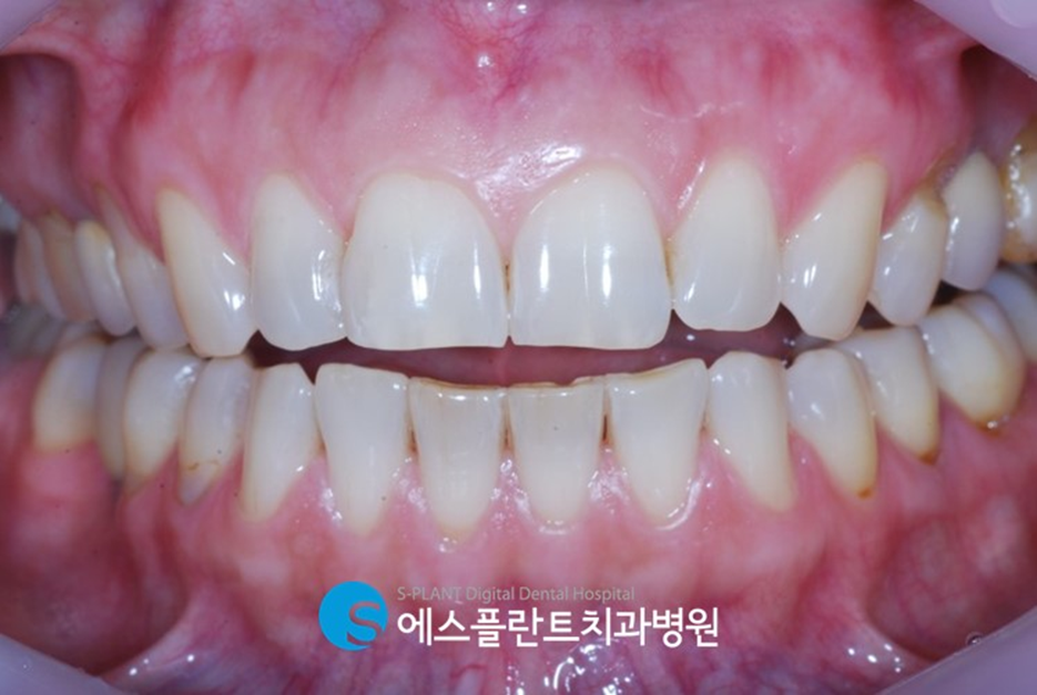앞니 콤플렉스가 있다면?! 강남 심미보철 잘하는 치과, 에스플란트치과병원의 심미보철로 개선 관련 이미지 2