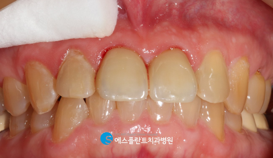 자연스러운 앞니 보철을 원한다면?! 압구정 앞니보철 잘하는 치과, 에스플란트치과병원에서 관련 이미지 5