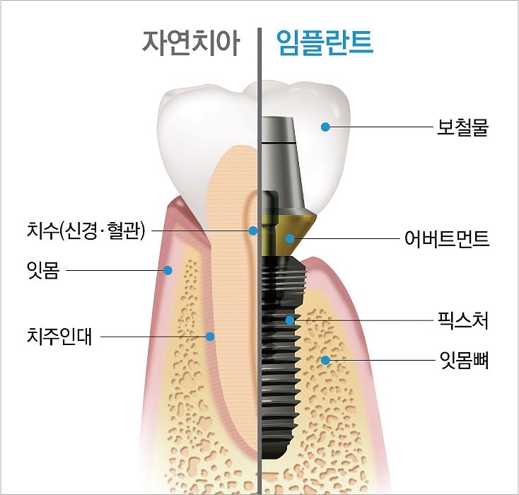 임플란트 구성의 모든 것 강남임플란트 에스플란트치과병원 관련 이미지 5