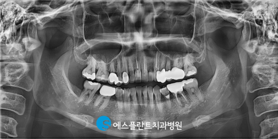 전치부 치근외흡수로 인한 임플란트 시술이 가능한 치과, 강남 에스플란트치과병원 관련 이미지 2