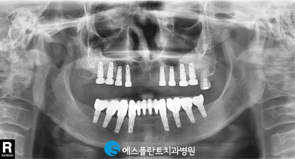 치아를 모두 상실했다면?전악임플란트로 자연치아와 같은 저작력을 되찾으세요! 관련 이미지 4