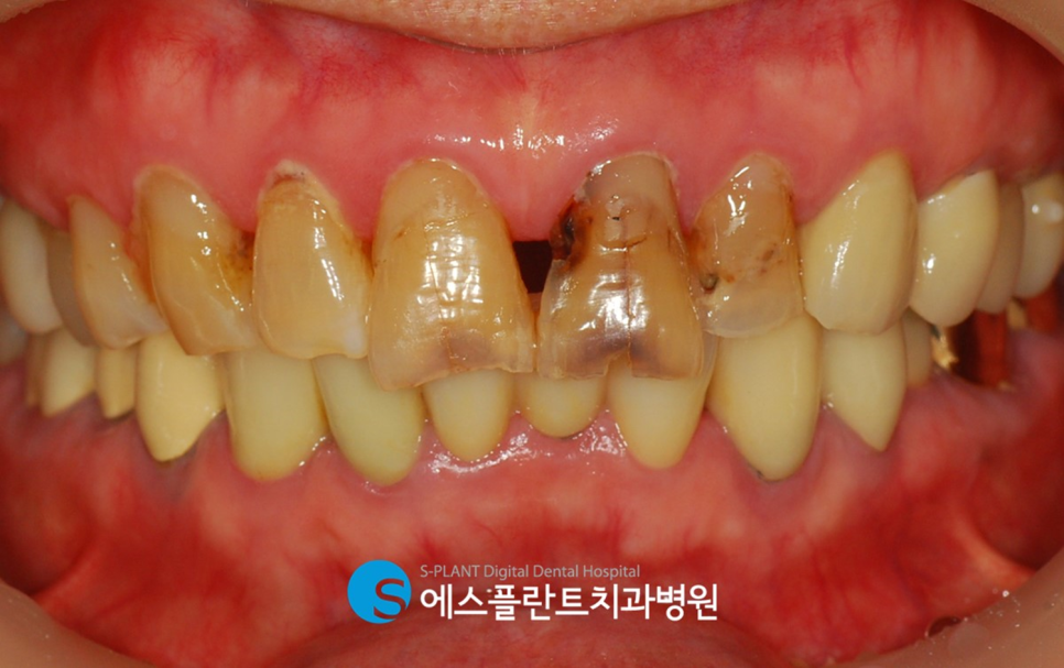 치아노화로 인한 기능 및 심미적인 부분의 개선을 원한다면?! 강남 앞니 심미보철 잘하는 치과 에스플란트치과병원에서 관련 이미지 2