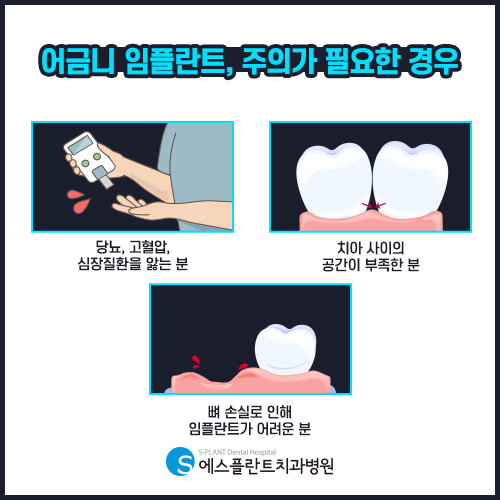 높은 강도와 정확도가 중요한 어금니 임플란트 [에스플란트 치과병원] 관련 이미지 7