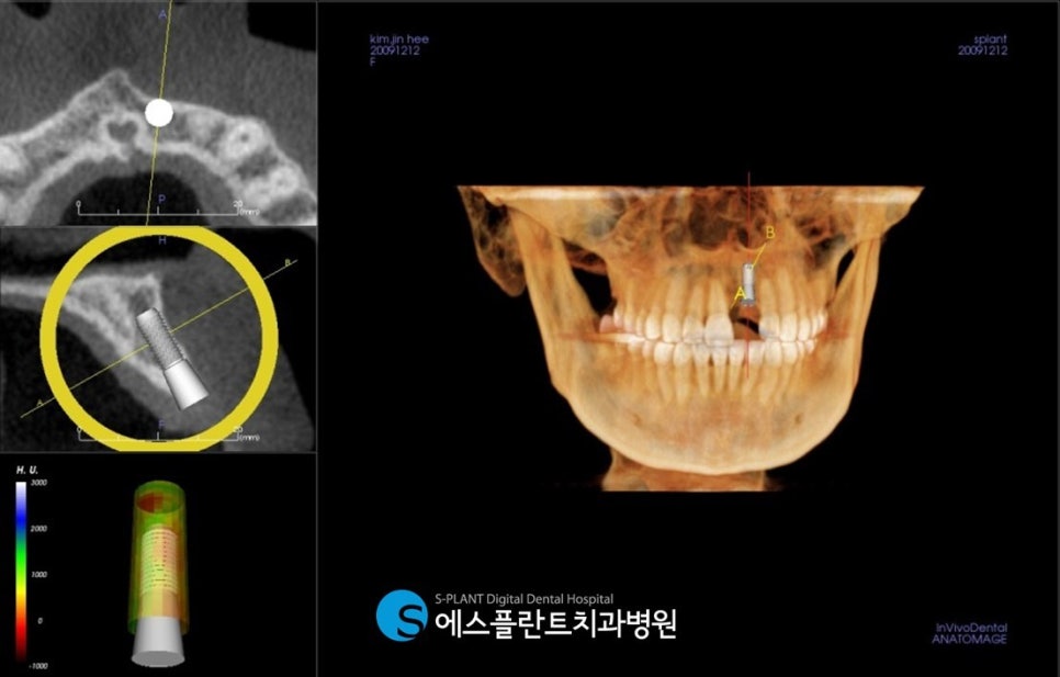 심미성과 기능성을 모두 고려한 압구정로데오 에스플란트치과병원의 앞니 임플란트 (가이드 임플란트) 관련 이미지 5