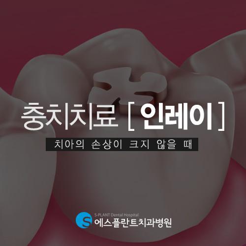 충치치료,내구성이뛰어난인레이로치아보존 관련 이미지 1