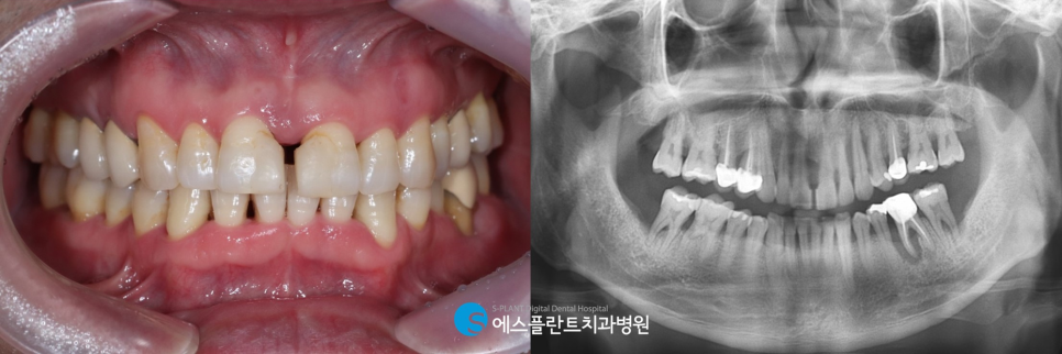 강남 디지털 가이드 임플란트를 통해 오차를 줄이며 안정적으로 식립 관련 이미지 2