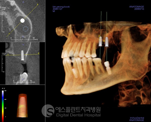 [임플란트 잘하는 곳] 시술이 중요한 어금니 임플란트 관련 이미지 1