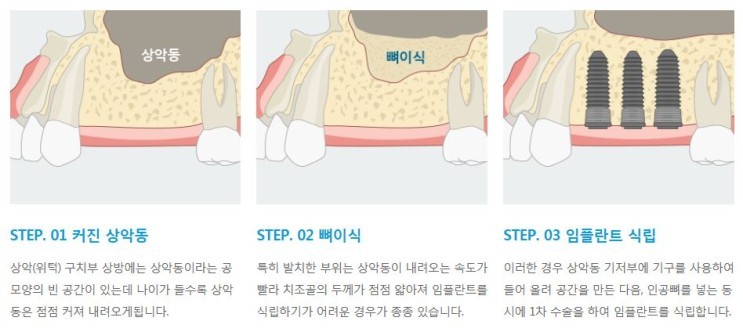 어금니 임플란트 하러 갔더니 상악동 거상술이 필요하대요!! 관련 이미지 4
