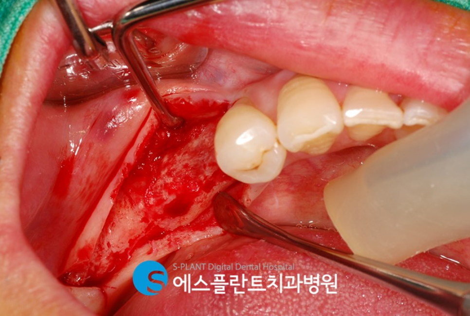골이식을 동반한 고난이도 임플란트 시술 잘하는 치과, 에스플란트치과병원 관련 이미지 7