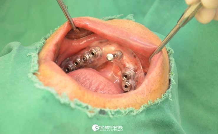 [CT임플란트] 3D CT 임플란트, 아나토마지 가이드 임플란트 관련 이미지 5