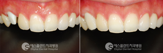 잇몸에 임플란트 기둥이 비쳐서 고민이었던 환자분의 사례 관련 이미지 5