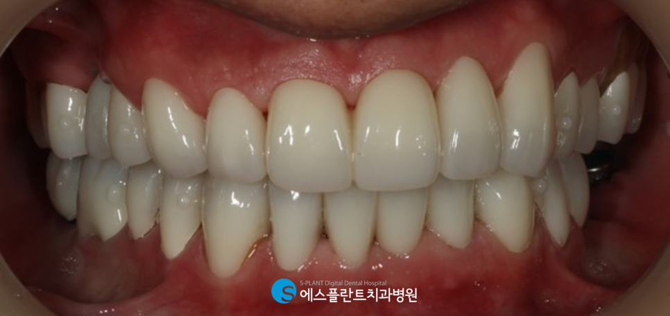심미보철 치료 잘하는 치과 에스플란트치과병원의 지르코니아 보철 관련 이미지 6